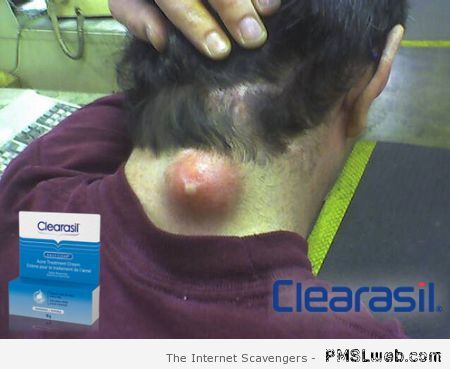 Giant pimple Clearasil parody – Gross pictures at PMSLweb.com