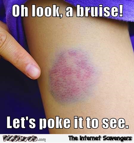 Funny bruise meme @PMSLweb.com