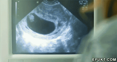 Hilarious ultrasound gif @PMSLweb.com